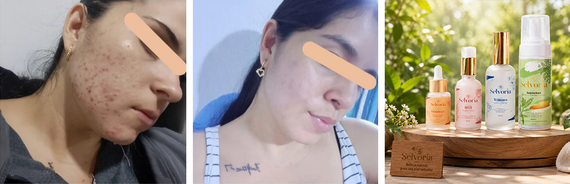Rutina antiacne